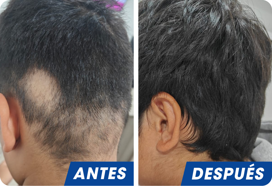 ALOPECIA