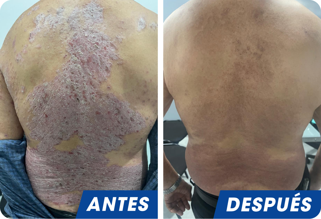 PSORIASIS