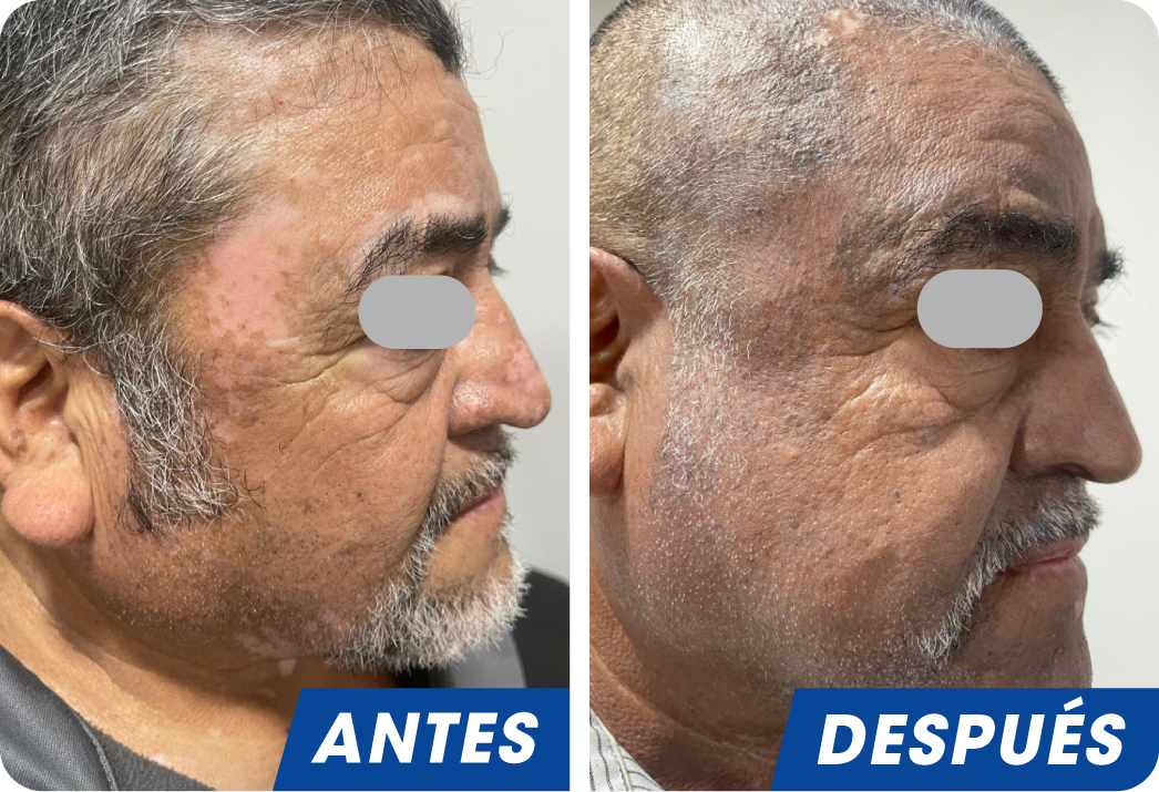 VITILIGO