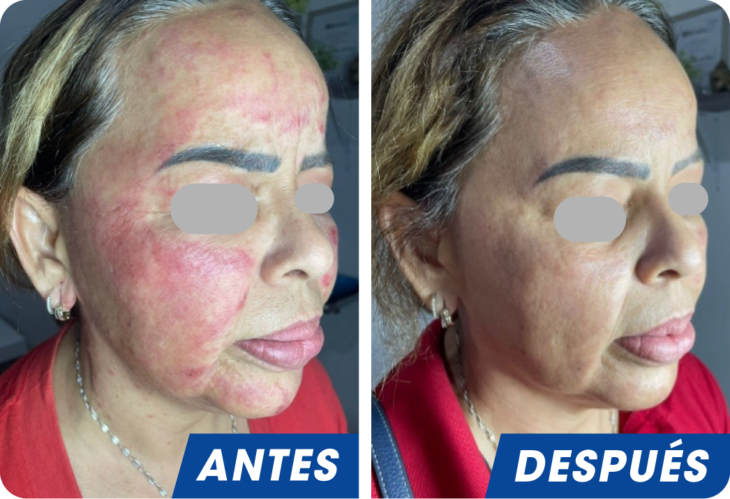 DERMATITIS CONTACTO