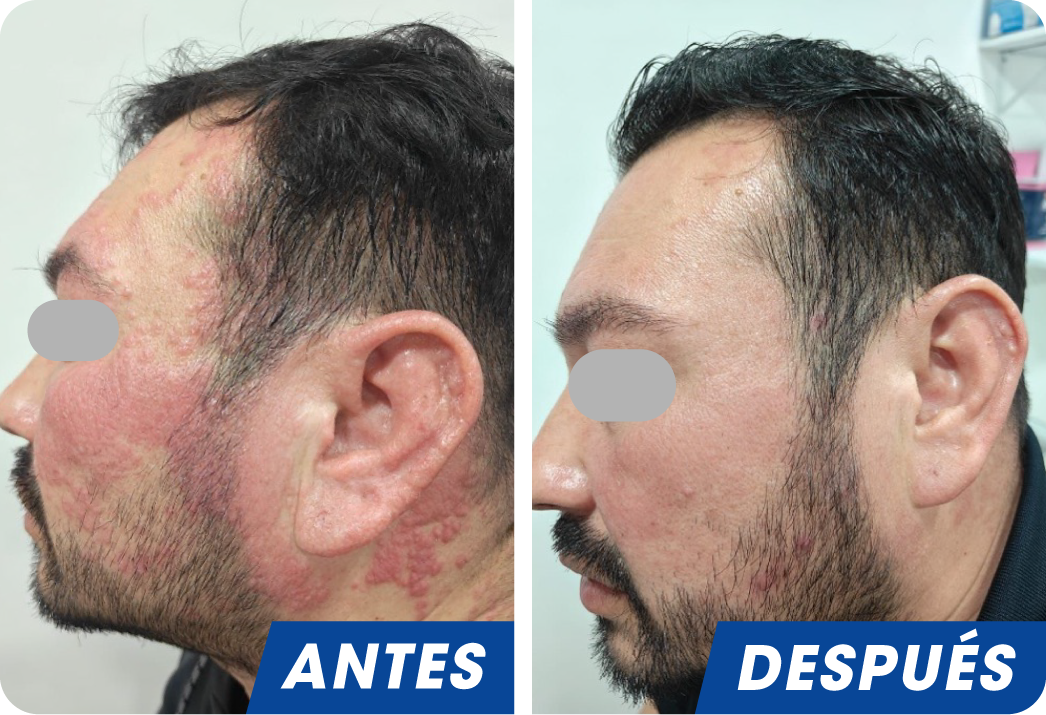 REACCIÓN ALÉRGICA