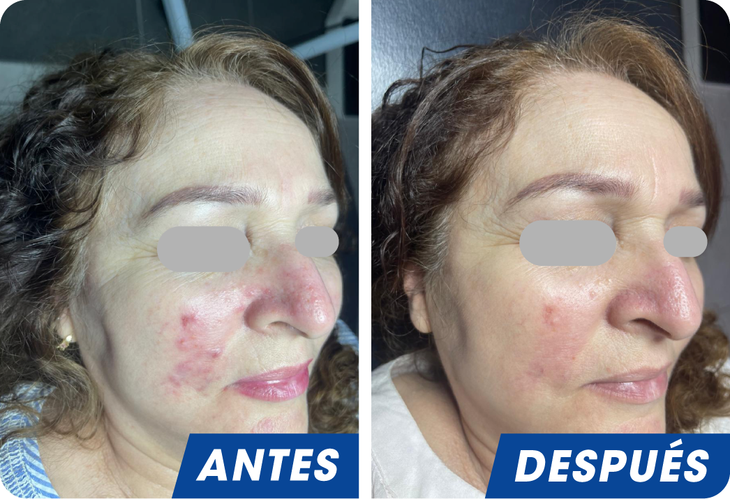 ROSACEA